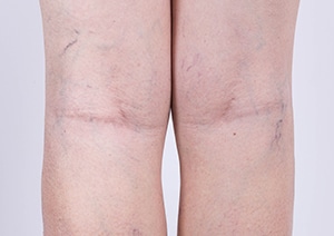 Varicose Veins 101: What really causes them and what can I do to prevent  and treat them? — Cosmetic Medical Clinic